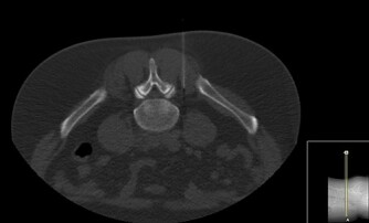 CT-Periradikulärinfiltration